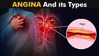 What is Angina And How it Works  Types Causes Symptoms and treatment 3D Animation [upl. by Neetsirhc121]