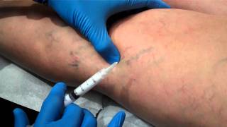 Foam Sclerotherapy superficial varicose vein by Dr Khalil Fattahi MD [upl. by Ailina]