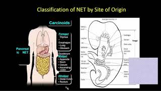 Current Management of Neuroendocrine Tumors at Mount Sinai [upl. by Alane]