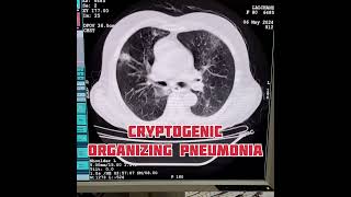 Cryptogenic organizing pneumonia pneumonia radiology shortvideo [upl. by Hrutkay]