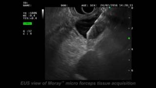 MORAY™ Micro Forceps Case Report 4 Dr Pham [upl. by Aya]