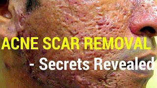 How to treat acne scars Dermatology Secrets revealed [upl. by Aiekal]