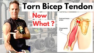 Torn or Ruptured Bicep Tendon What you need to know [upl. by Rebmetpes175]