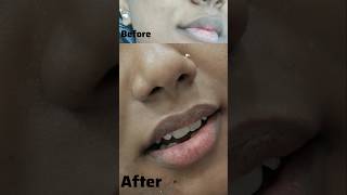 Lip treatment love skincare hydrafacial glutathioneiv chennai skincaretips [upl. by Aicilla]