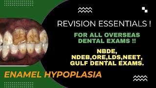 Understanding ENAMEL HYPOLPASIA Essential Knowledge for Gulf Dental Exams amp Interviews [upl. by Llenehs]