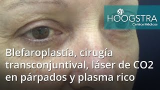 Blefaroplastía cirugía transconjuntival láser de CO2 en párpados y plasma rico 16139 [upl. by Nalad]