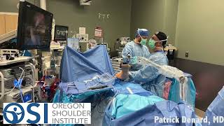 How Will I Be Positioned During Shoulder Arthroscopy [upl. by Colb250]