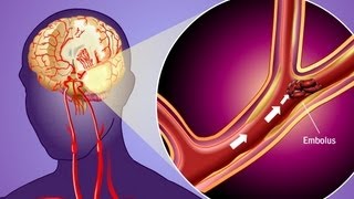 Stroke Prevention amp Transient Ischemic Attack TIA [upl. by Buffy]