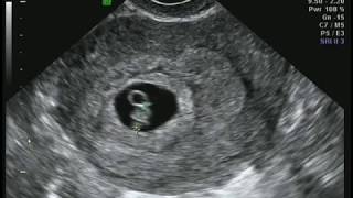 6 weeks 5 days ultrasound [upl. by Ecirtahs]