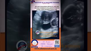 Subserosal myoma with pregnancy ultrasoundtraining ultrasound ultrasoundcourse [upl. by Misak841]