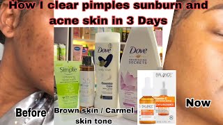 How I clear pimples sunburn uneven skin and acne skin in 3days omonsnaturalglow [upl. by Hsak485]