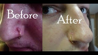 How to Get Rid of a Keloid in a week [upl. by Nosnor]