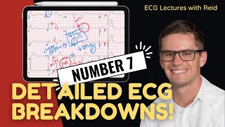 EKG Test Yourself  ECG Case Study 7 [upl. by Cross491]