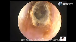 Treatment of fungal otitis externa by ear endoscope for 12 minutes 耳内镜处理真菌性外耳道炎，12分钟 [upl. by Zorana]