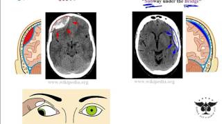 Subdural Hematoma VS Epidural Hematoma  Intracranial Hemorrhages [upl. by Janaya]