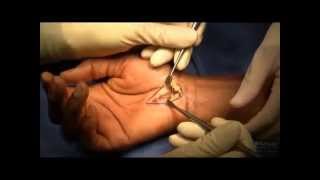 Carpal tunnel surgery and hand scars [upl. by Kerat]