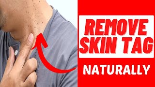 Best Skin Tag Removal Product Reviews  Skin Tag Removal Product That Really Works [upl. by Tamis]