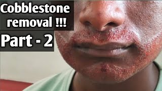 How to cure cobblestones cobblestone removal part 2  tamil [upl. by Cissy]