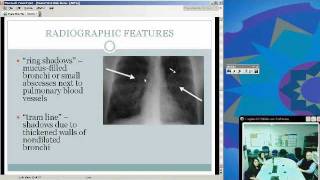 Allergic Bronchopulmonary Aspergillosis Sunena Argo MD [upl. by Gunter]