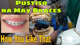 Pustiso with Retainer Like Braces How You Like That Pustiso with Braces Denture with braces [upl. by Einuj]