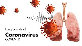 Sounds of Coronavirus COVID19  Lung Sounds [upl. by Merline531]