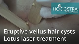 Eruptive vellus hair cysts  Lotus laser treatment 20234 [upl. by Atsillak]