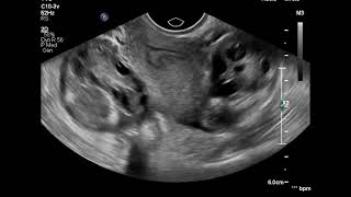 Bilateral salpingitis ultrasound [upl. by Novaj]