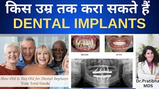 किस उम्र तक करा सकते हैं डेंटल इम्प्लांट्स  Age of Getting Implants dentalimplants  Dr Pratibha [upl. by Erual]