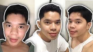 NOSE THREAD LIFT AFTER 6 MONTHS 👃🏻  LA Rabino [upl. by Pamella]