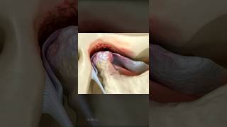 Dislocated Degenerating TMJ Disc [upl. by Leidgam]