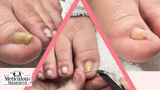 Ingrown Toenail Pedicure [upl. by Ynaffi]