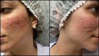 3ª Sessão do Microagulhamento para cicatrizes de acne  Dermapen [upl. by Lleuqar]