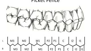 STATIC OCCLUSION  Occlusal Contacts amp Picket Fence [upl. by Grose]