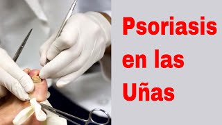 🖐🖐 Psoriasis de Uñas  Psoriasis en las Uñas 🖐🖐 [upl. by Remliw]