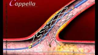 Stent insertion [upl. by Steep]