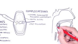 Acute Tonsillitis  causes viral bacterial pathophysiology treatment tonsillectomy [upl. by Ahcsropal22]