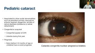 Lecture Surgical Approach to Pediatric Cataracts [upl. by Fassold818]