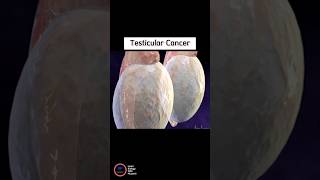 Testicular Cancer [upl. by Lareine]