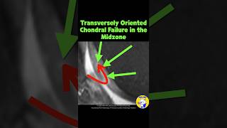 Fig 5A16 Transverse Chondral Flap Lesions in Midzone [upl. by Kubis527]