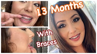 13 Months with BRACES  OverjetOverbite Correction Without Extractions  Damon Braces [upl. by Trager]