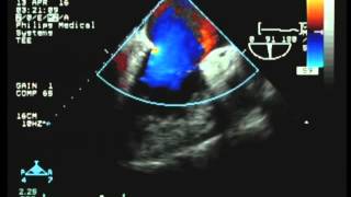 Intraoperative transesophageal echocardiography [upl. by Nnylyrehc972]