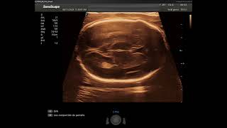 Evaluación de un feto de 24 semanas con el transductor lineal del Sonoscape P40 Elite [upl. by Ocimad]