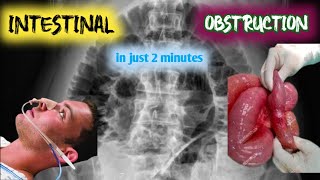 intestinal obstruction  bowel obstruction [upl. by Palocz]