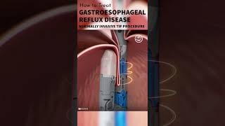 Gastroesophageal Reflux Disease GERD Treatment shorts tutorial medical animation surgmedia [upl. by Anitsirk]