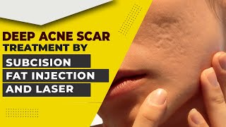 Deep Acne Scar Treatment Laser Fat Injection and Subcision  Acne Scar Treatment in Delhi [upl. by Names]