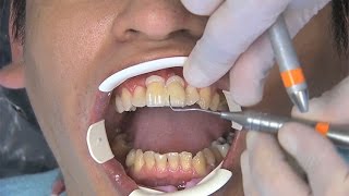 Chairside Live Episode 79 This Anterior CrossBite Patient Wanted Veneers [upl. by Thorne]