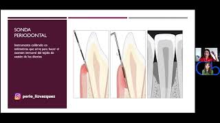 Sonda Periodontal qué es función e importancia [upl. by Tiphany]