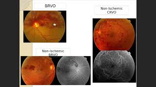 Ophthalmology module online quot Kasr AlAinyquot  13 Retinal Vascular Occlusionsamp Neovascular Membrane [upl. by Llekcir]