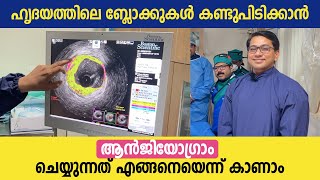 ഹൃദയത്തിലെ ബ്ലോക്കുകൾ കണ്ടുപിടിക്കാൻ ആൻജിയോഗ്രാം ചെയ്യുന്നത് കാണാം  Angiogram Malayalam video [upl. by Kenn]