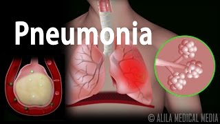 Pneumonia Animation [upl. by Amorete]